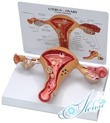 Эндометриоз шейки матки: лечение, симптомы, при беременности