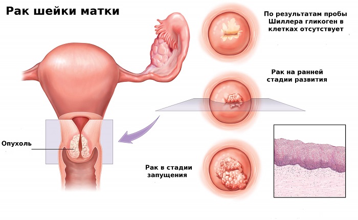 Развитие рака на картинке