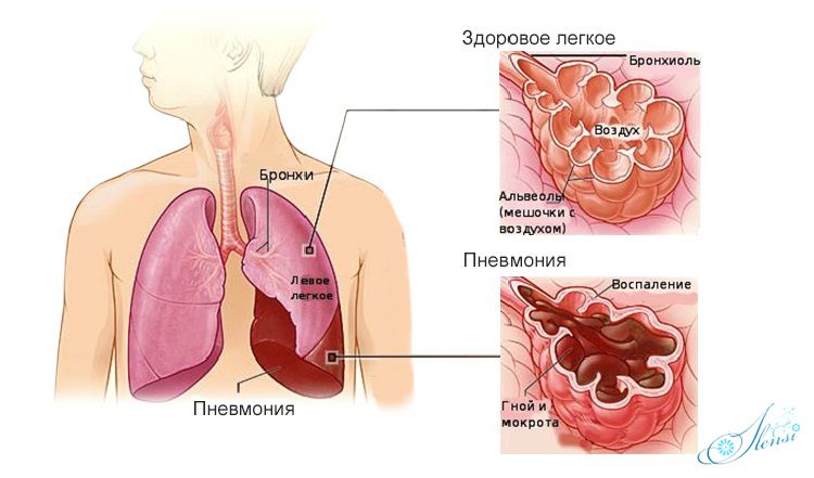 легкое человека при пневмонии