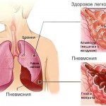 пневмония легких