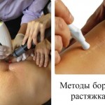 Методы борьбы с растяжками
