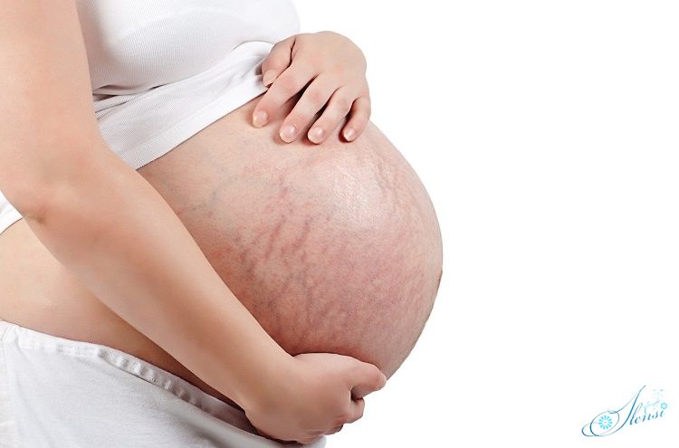 При поздних сроках беременности появляются растяжки на животе