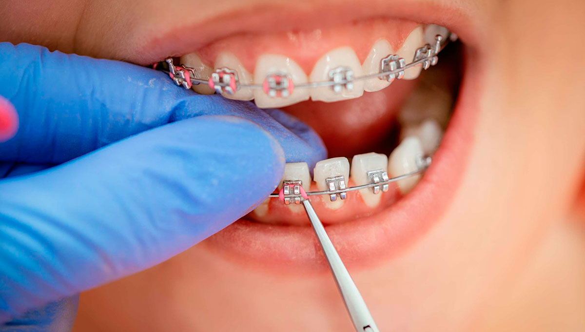 Установка брекетов на зубы: особенности процедуры