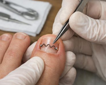 Корректирующая пластина на ноготь: когда и зачем её ставят, чего ждать и как выбрать специалиста