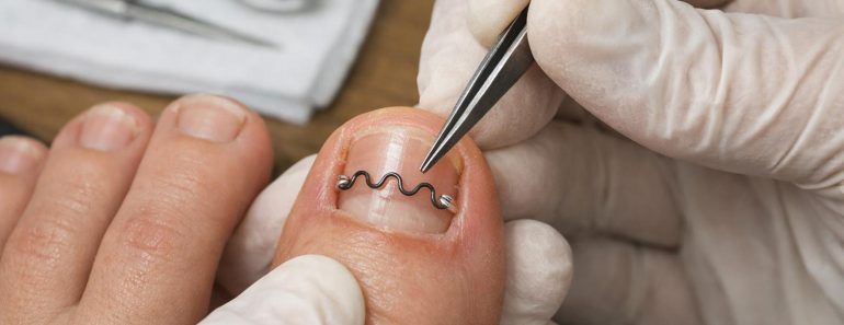 Корректирующая пластина на ноготь: когда и зачем её ставят, чего ждать и как выбрать специалиста